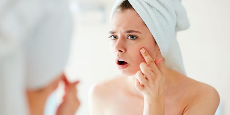 Acne, alta prestazione per il farmaco sperimentale in gel IDP-126 nel secondo studio di fase III