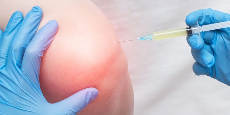 Artrosi del ginocchio, un’iniezione di cellule staminali potrebbe ridurre infiammazione e dolore
