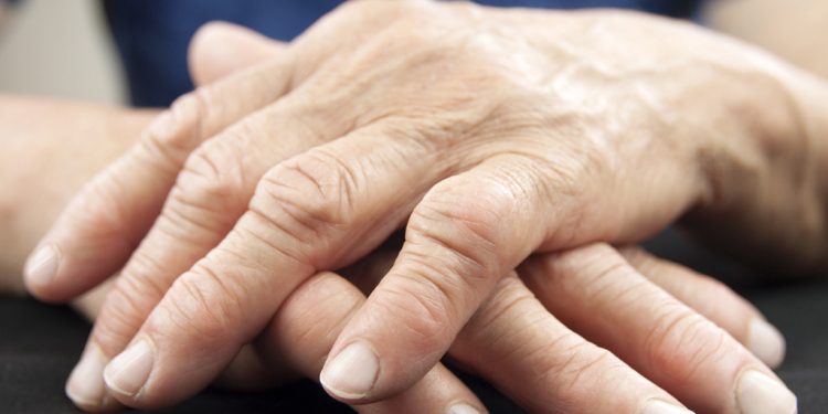 Baricitinib, confermata efficacia e tollerabilità del farmaco nel trattamento persistente dei pazienti con artrite reumatoide