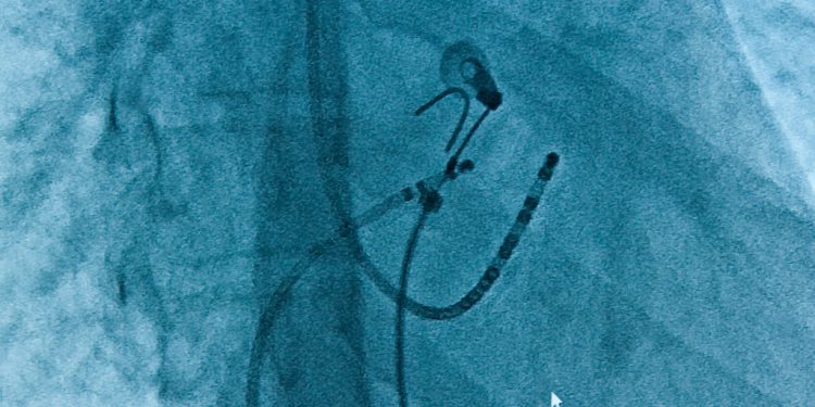 Ablazione cardiaca, ora si fa con il catetere DiamondTemp