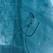 Ablazione cardiaca, ora si fa con il catetere DiamondTemp