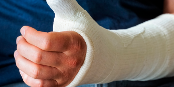 Fratture ossee e antinfiammatori: meglio assumerli durante il giorno