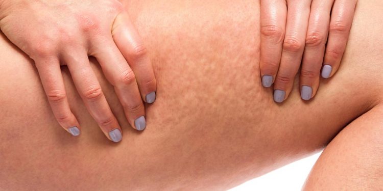 Cellulite: l’acqua con magnesio un’arma in più per combatterla