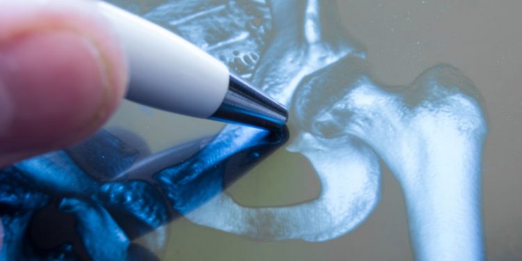 Protesi dell’anca: cos’è, come funziona e quando sottoporsi all’intervento chirurgico