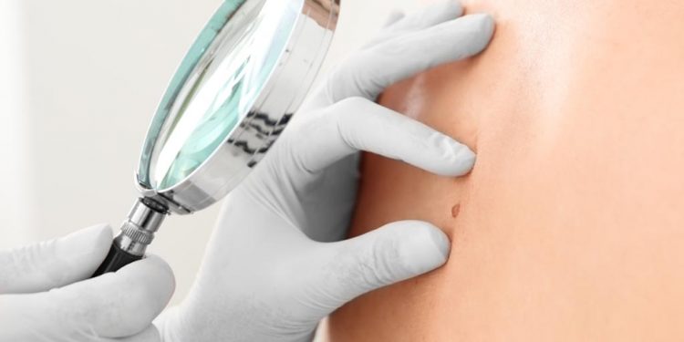 Dermatopatologia, dermatoscopia e microscopia confocale: le nuove armi nella lotta ai tumori della pelle