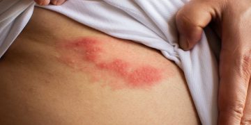 Herpes Zoster: cos’è, sintomi e cure