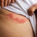 Herpes Zoster: cos’è, sintomi e cure