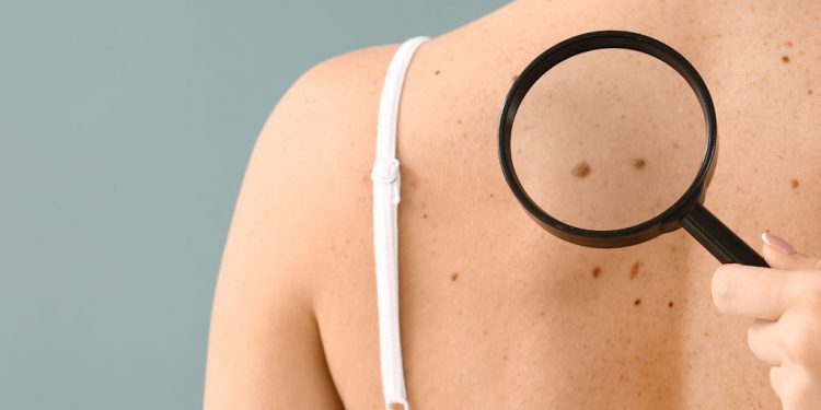 La teledermatologia come arma nella prevenzione dei tumori della pelle