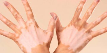 Vitiligine: non solo una condizione estetica, ma una patologia autoimmune