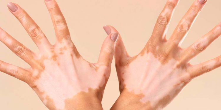 Vitiligine: non solo una condizione estetica, ma una patologia autoimmune