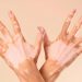 Vitiligine: non solo una condizione estetica, ma una patologia autoimmune